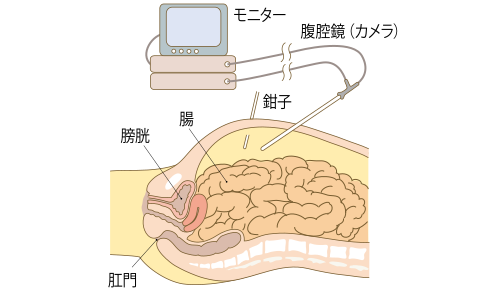 结直肠癌腹腔镜手术