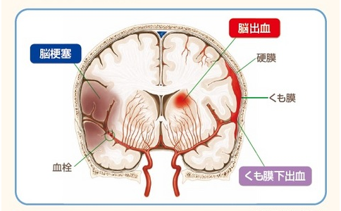 脑梗康复治疗