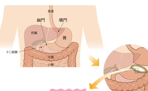 日本胃癌药物治疗