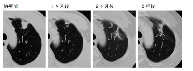 质子治疗癌症