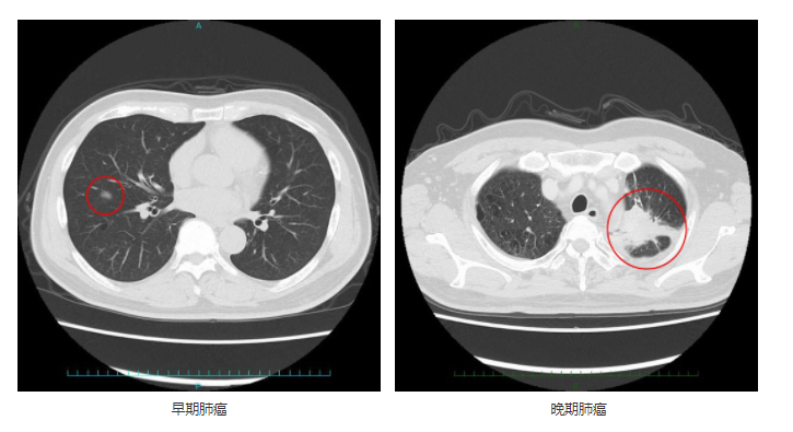 早期肺癌与晚期肺癌的CT影像