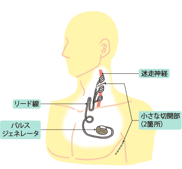 日本治疗癫痫