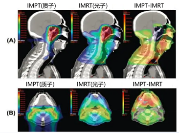 质子治疗鼻咽癌