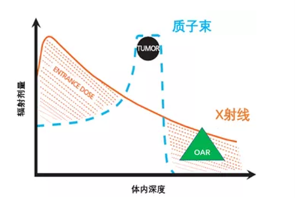 质子治疗鼻咽癌