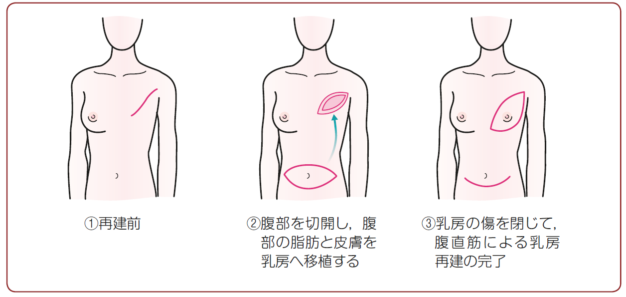 乳房重建