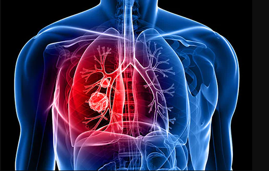 肺癌危险因素有哪些，如何有效筛查？,