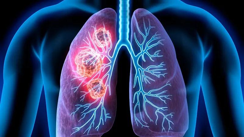 肺癌筛查