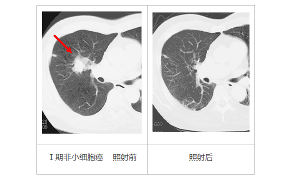日本肺癌治疗