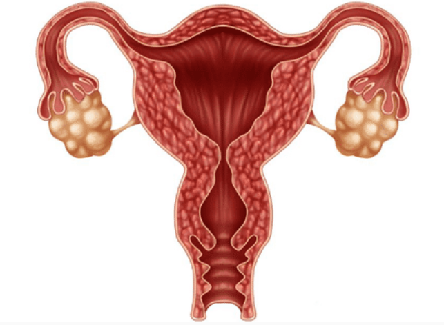 卵巢癌美国日本看病流程费用