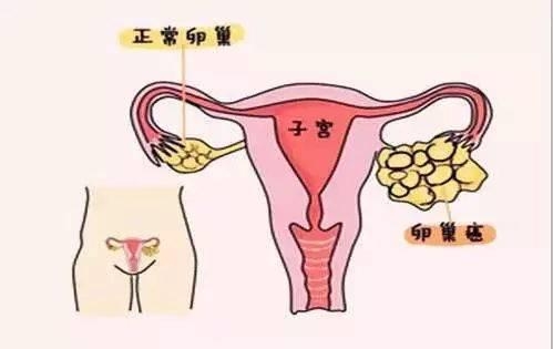 卵巢癌美国日本看病流程费用