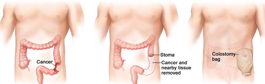 结直肠癌肝转移手术治疗,结直肠癌肝转移治疗,手术治疗肠癌肝转移