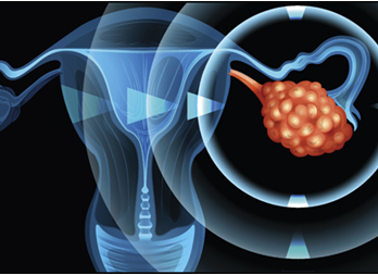 卵巢癌出国看病靠谱吗，卵巢癌日本美国治疗的效果