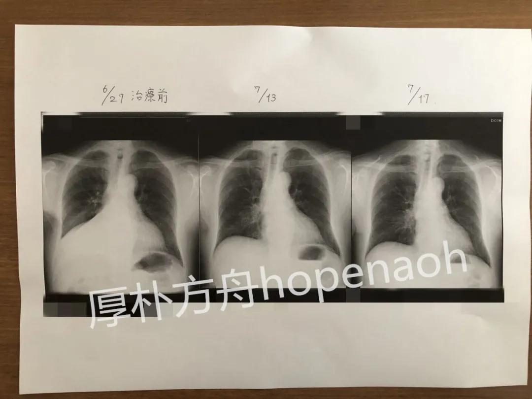 日本治疗肺癌