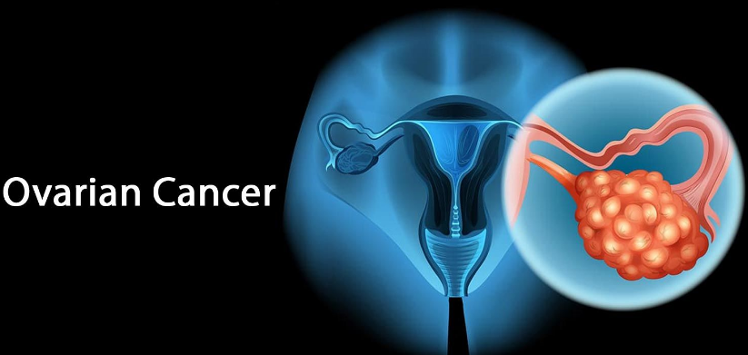 美国卵巢癌如何治疗，美国卵巢癌新药