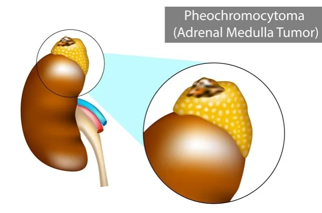 美国治疗嗜铬细胞瘤