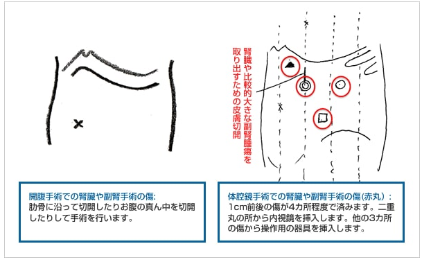 肾癌腹腔镜手术