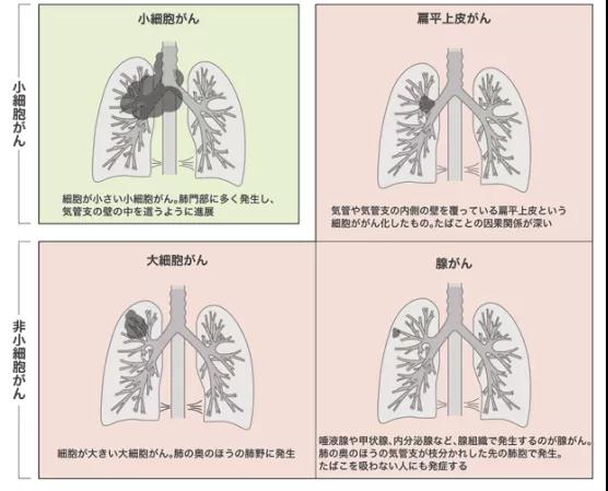 肺癌四种类型