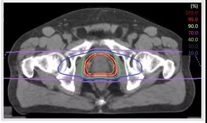 重离子治疗前列腺癌