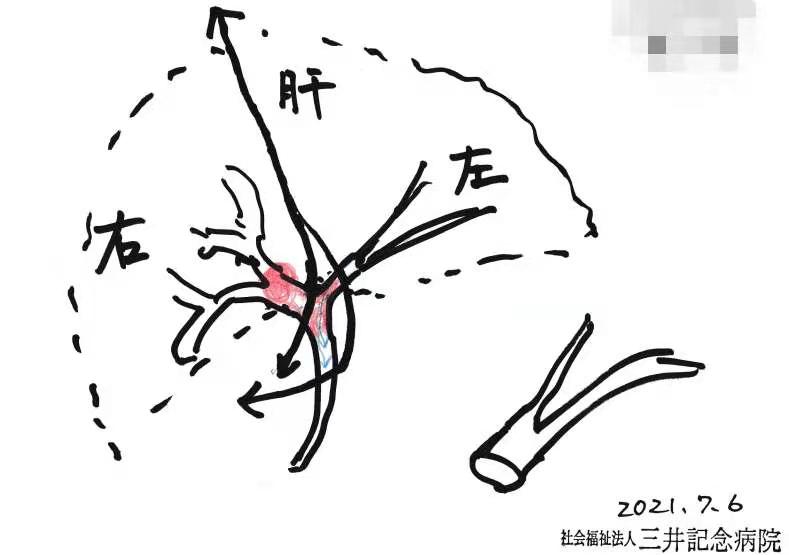 胆管癌手术治疗