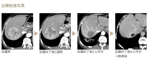 肝癌质子治疗