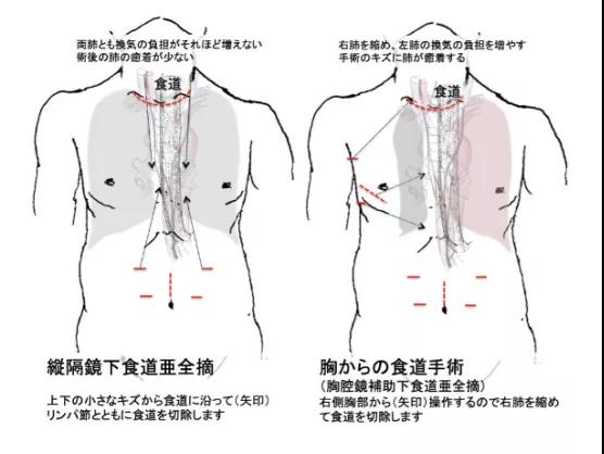 三井记念医院治疗食管癌