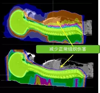 质子治疗