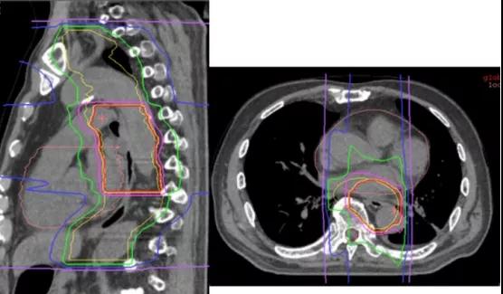 重离子治疗食管癌的效果
