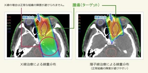 日本质子治疗儿童肿瘤医院
