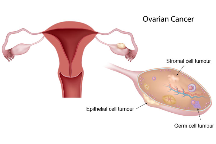 卵巢癌