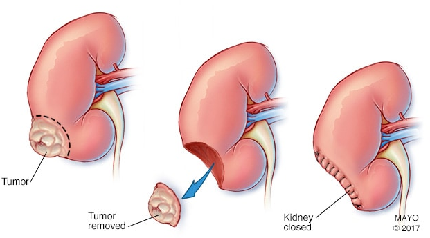肾癌手术治疗