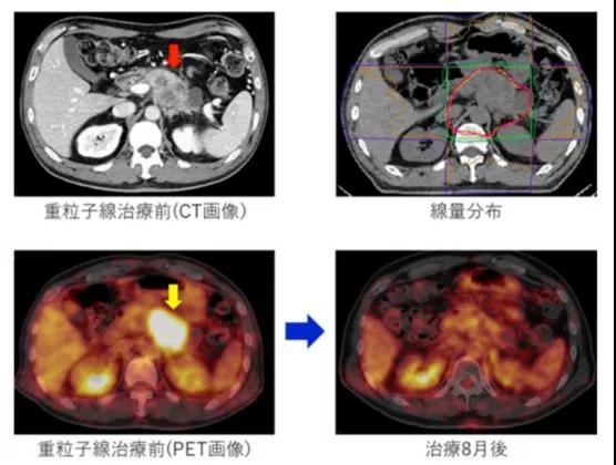 质子重离子治疗胰腺癌