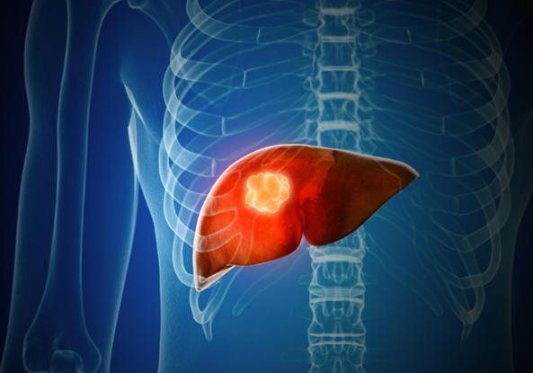 质子重离子治疗肝癌