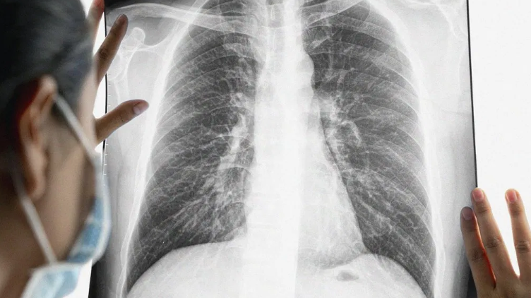 肺癌诊治误区
