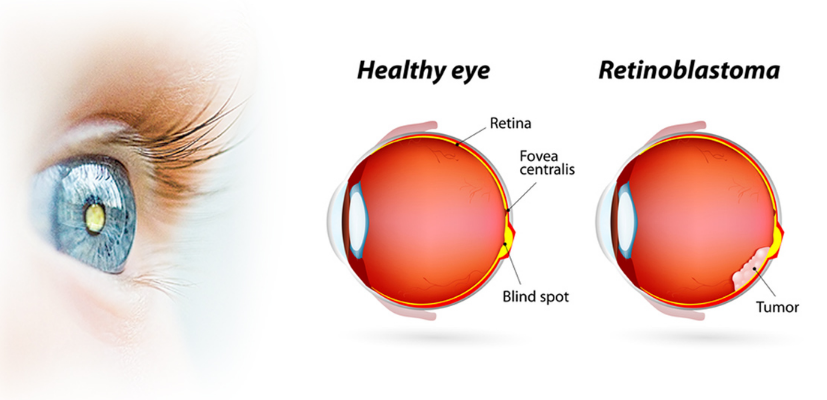 视网膜母细胞瘤手术治疗