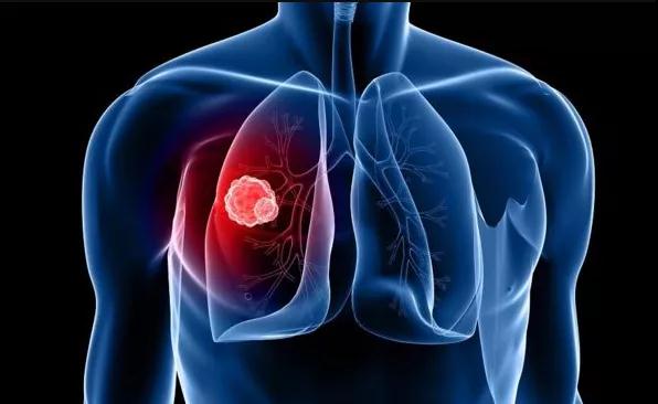 肺癌治疗方法