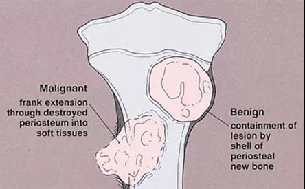 骨与软组织肿瘤治疗方法