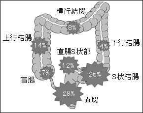 大肠癌