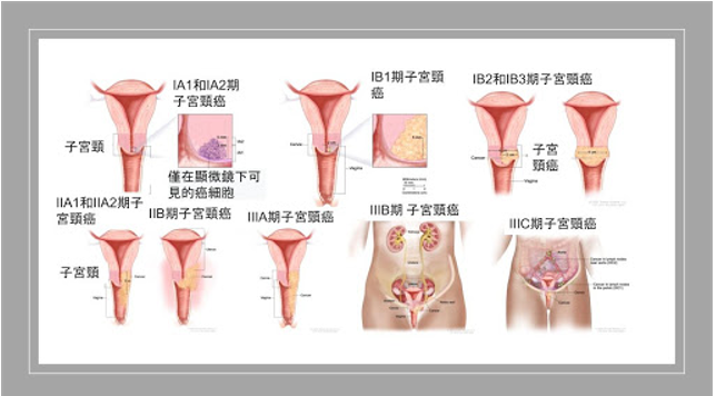 宫颈癌