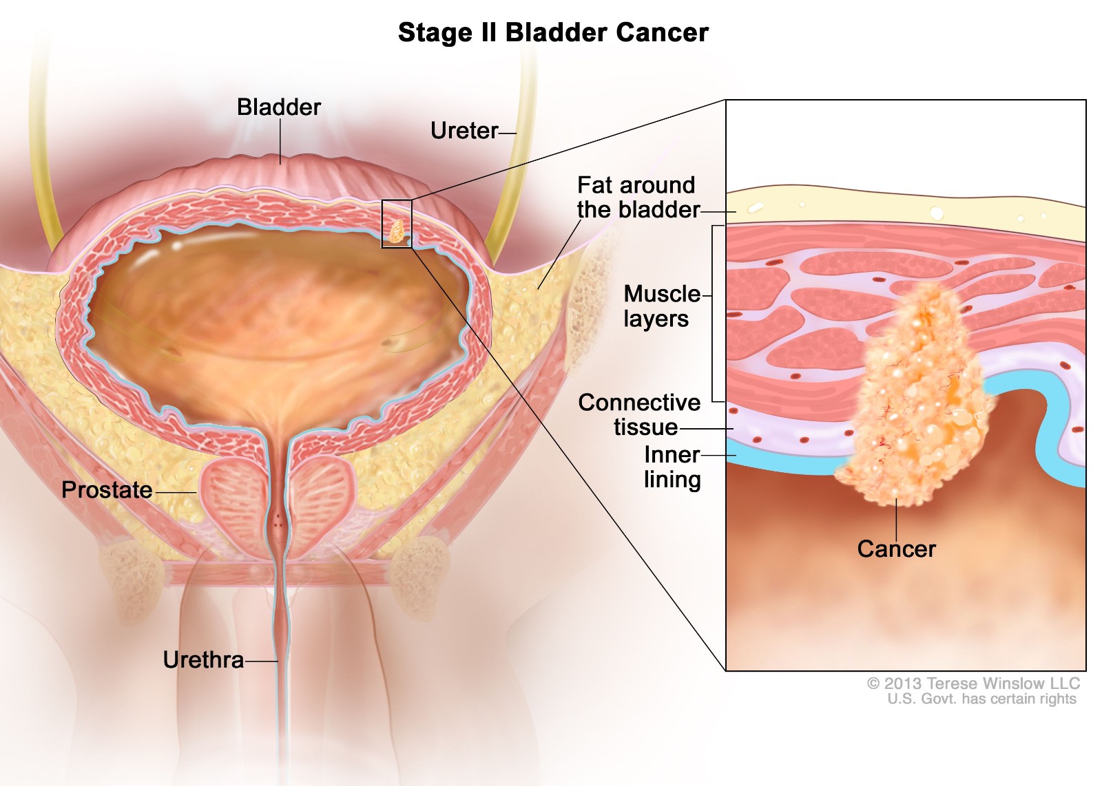 膀胱癌治疗
