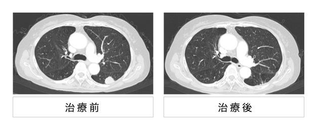 日本重离子治疗肺癌媲美手术