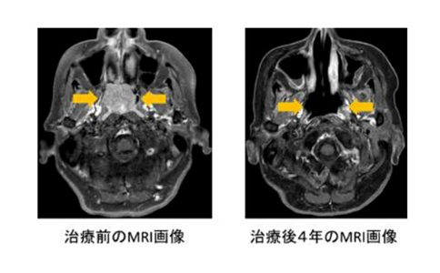 日本重离子治疗头颈部肿瘤
