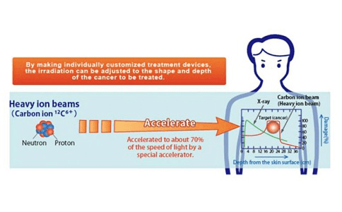 日本重离子射线治疗