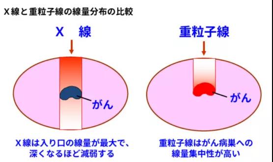 日本重离子治疗医院