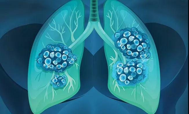 非小细胞肺癌新辅助治疗