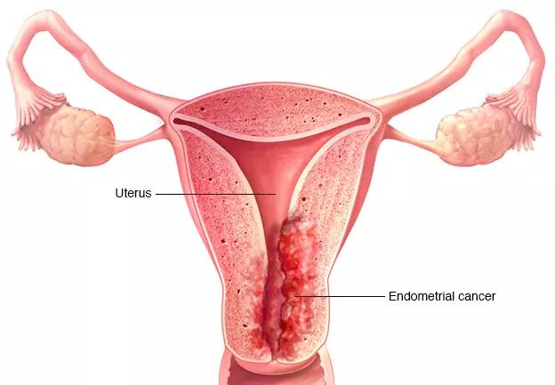 子宫内膜癌症状