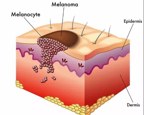 黑色素瘤治疗,晚期黑色素瘤治疗,靶向治疗黑色素瘤,免疫治疗黑色素瘤