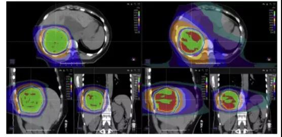 质子重离子治疗肝癌