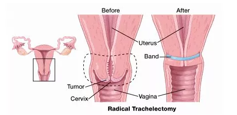 宫颈癌手术治疗