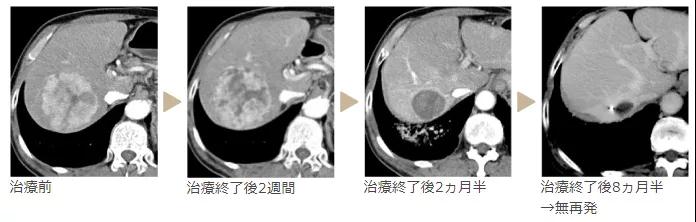 质子治疗肝癌