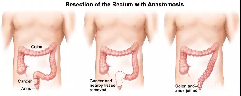 直肠癌保肛手术